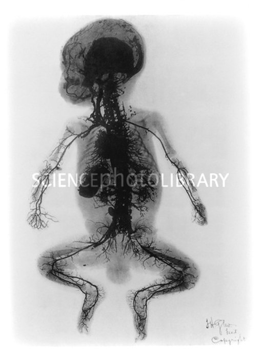 ^Рентгеновская артериограмма ребенка (1899 год).^b Ранний рентгеновский снимок, показывающий в мельчайших деталях артерии в теле ребенка. Этот рентгеновский снимок был сделан в 1899 году в больнице Святого Томаса в Лондоне и опубликован в журнале 
